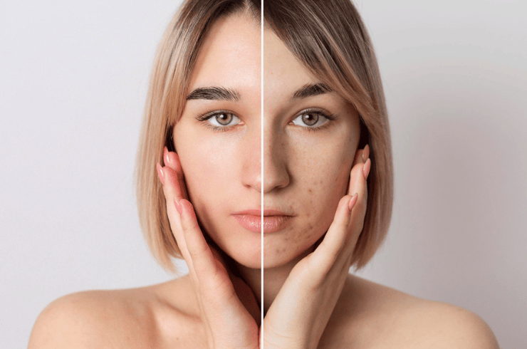 Pigmentation Treatment