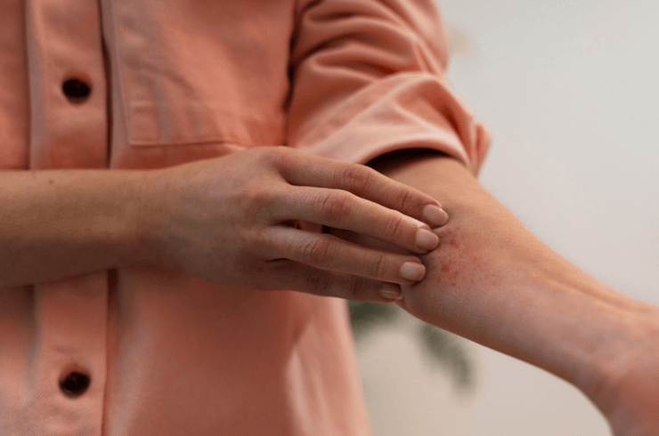 Skin Allergy Care
