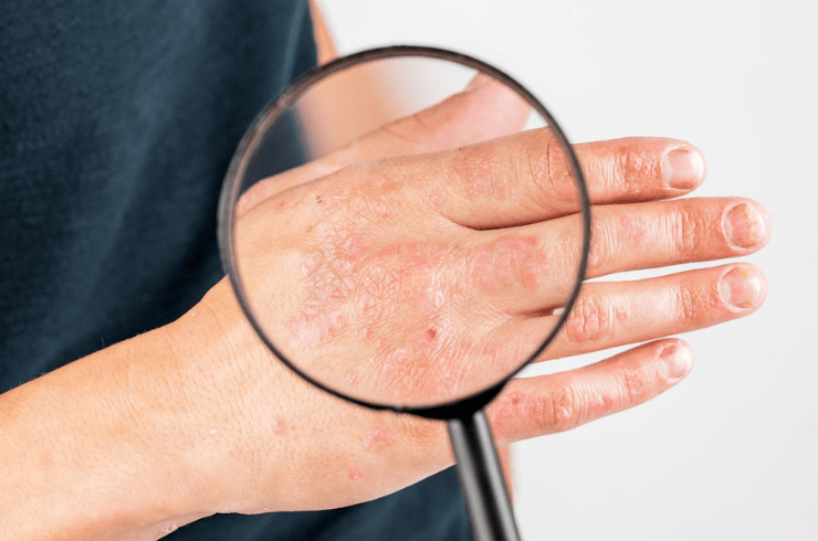 Skin Infections