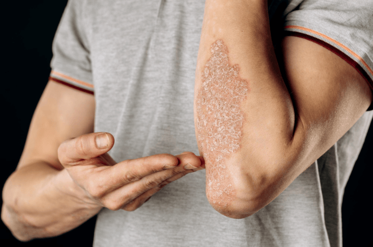 Psoriasis & Eczema Care